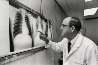 The look of asbestosis: Dr. Joseph Cowle of the Ontario Department of Health shows how tiny particles of asbestos that have lodged in human lungs cloud x-rays. At left is a normal lung. Several deaths in Metro have been attributed to asbestosis.